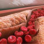 علائم افراد مبتلا به چربی خون | نشانه‌های هشداردهنده خاموش