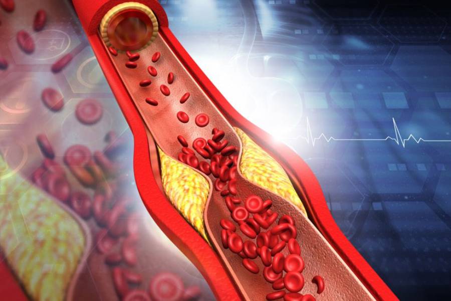 علائم و نشانه‌های چربی خون بالا